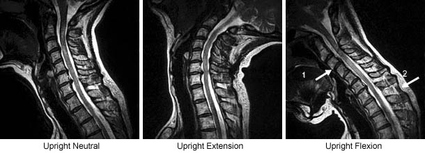 Fluctuating Instability And Central Spinal Stenosis