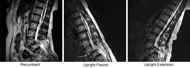 Postoperative Hypermobile Spinal Instability