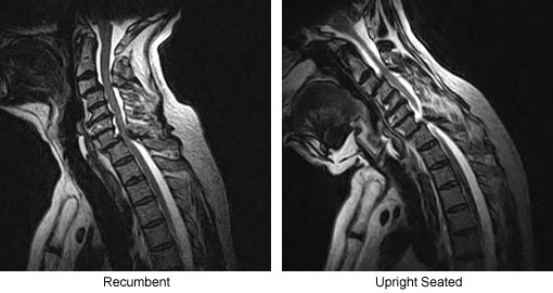Surgical Management Changed after Detection of an Unsuspected Cervical Spine Instability