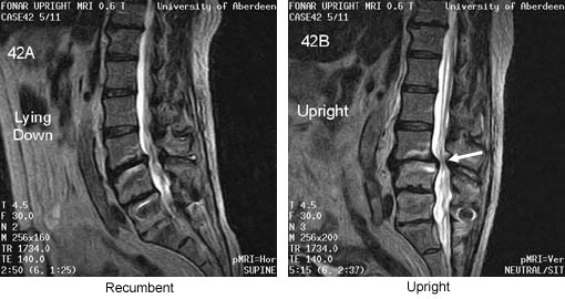 Unsuspected Anterolisthesis at L3/4 Following L4,5,S1 Fusion Revealed by Upright MRI Changes Patient Treatment