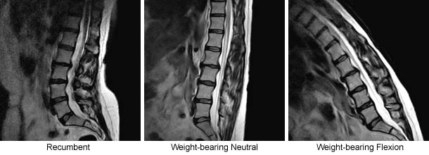 Hypermobile Spinal Instability Revealed by Upright MRI Scans