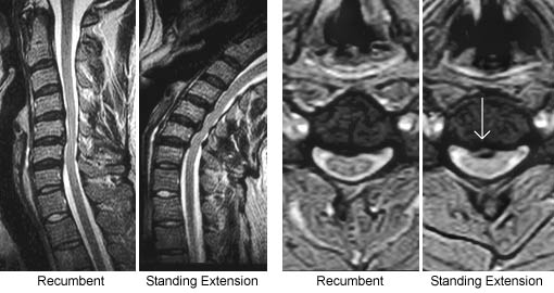 Fluctuating Spinal Stenosis & Position-Dependent Disc Herniation