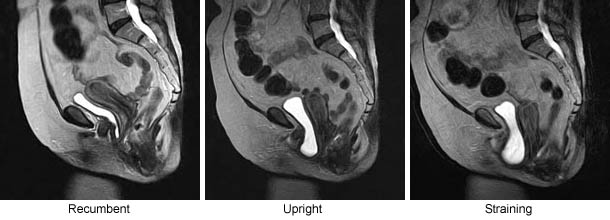 MRI Visualization of Position-Dependent Changes in the Pelvis: Pelvic Floor Dysfunction (PFD)